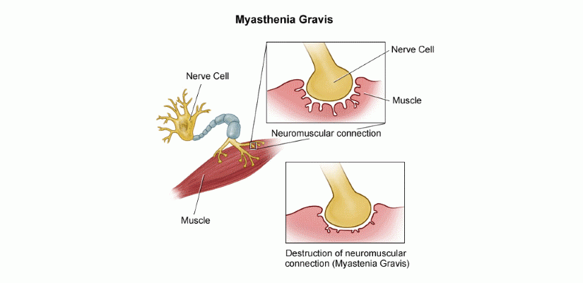 Miastenija gravis