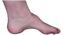 Charcot-Marie-Tooth - CMT