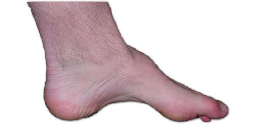 Charcot-Marie-Tooth - CMT